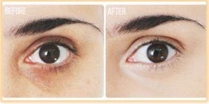 Get rid of Dark circles